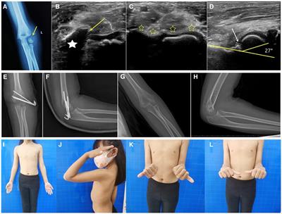 Criteria of ultrasound-guided closed reduction with percutaneous pinning in unstable humeral lateral condylar fractures: a three-center retrospective cohort study